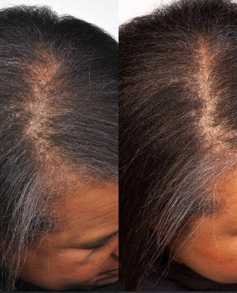 Theradome LH40 EVO Laserhelm - Hairgivers
