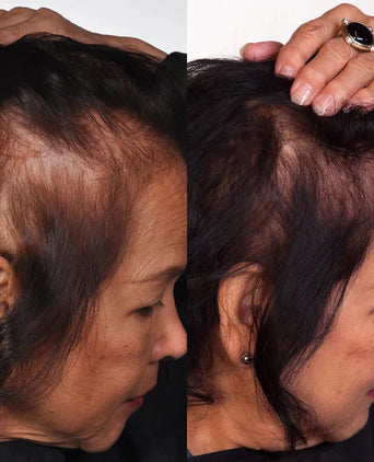 Theradome LH80 PRO Laserhelm - Hairgivers