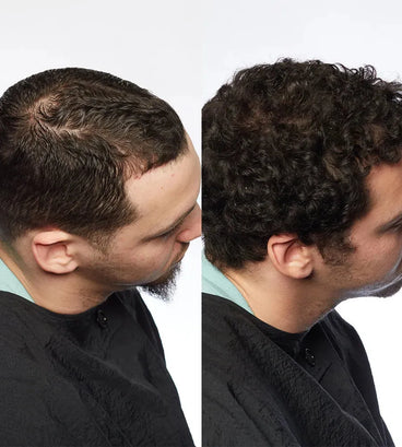 Theradome LH80 PRO Laserhelm - Hairgivers